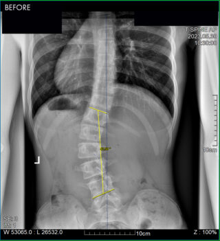 South Florida Scoliosis Center – Scoliosis Success Patient 4 BEFORE