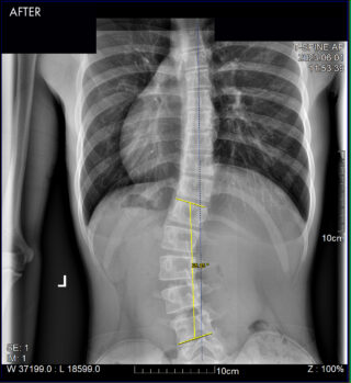 South Florida Scoliosis Center – Scoliosis Success Patient 4 AFTER