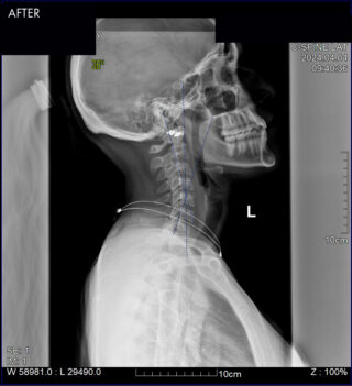 South Florida Scoliosis Center - Success Patient 1 - AFTER