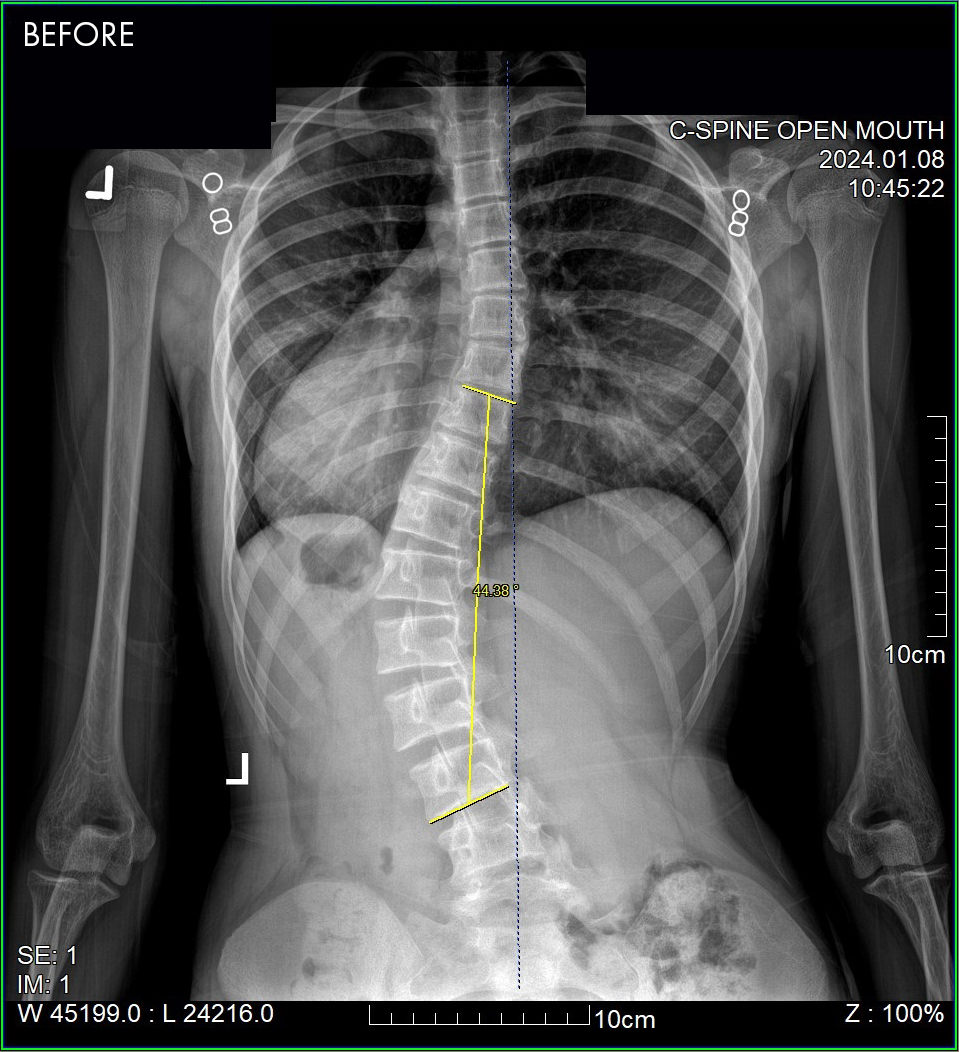 South Florida Scoliosis Center – Scoliosis Success Patient 2 BEFORE