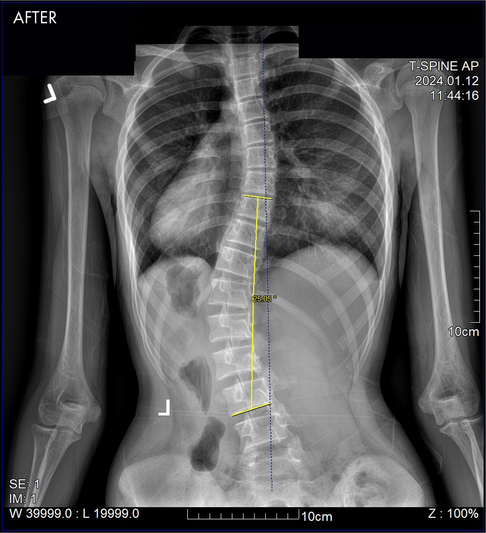 South Florida Scoliosis Center – Scoliosis Success Patient 2 AFTER