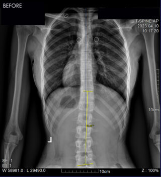 SouthFloridaScoliosisCenter–Success-Patient-3A-BEFORE