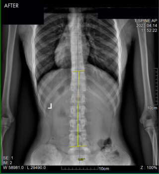 SouthFloridaScoliosisCenter–Success-Patient-3B-AFTER